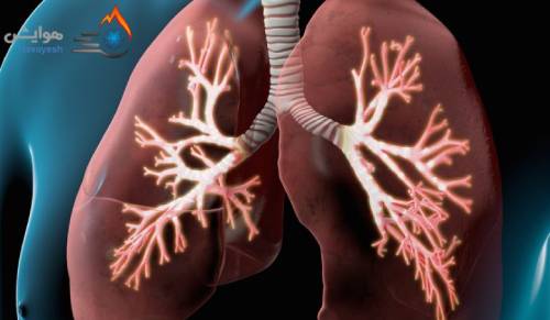 سونا بخار پزشکی و سلامت ریوی